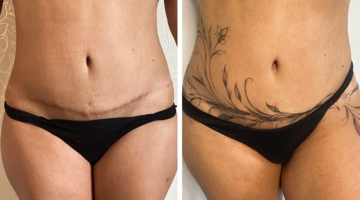 scar transformation