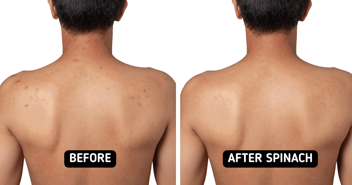 body acne