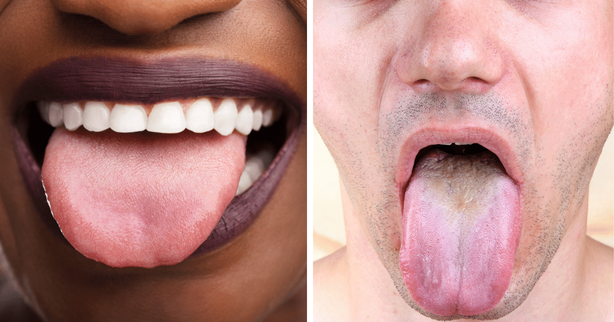white tongue