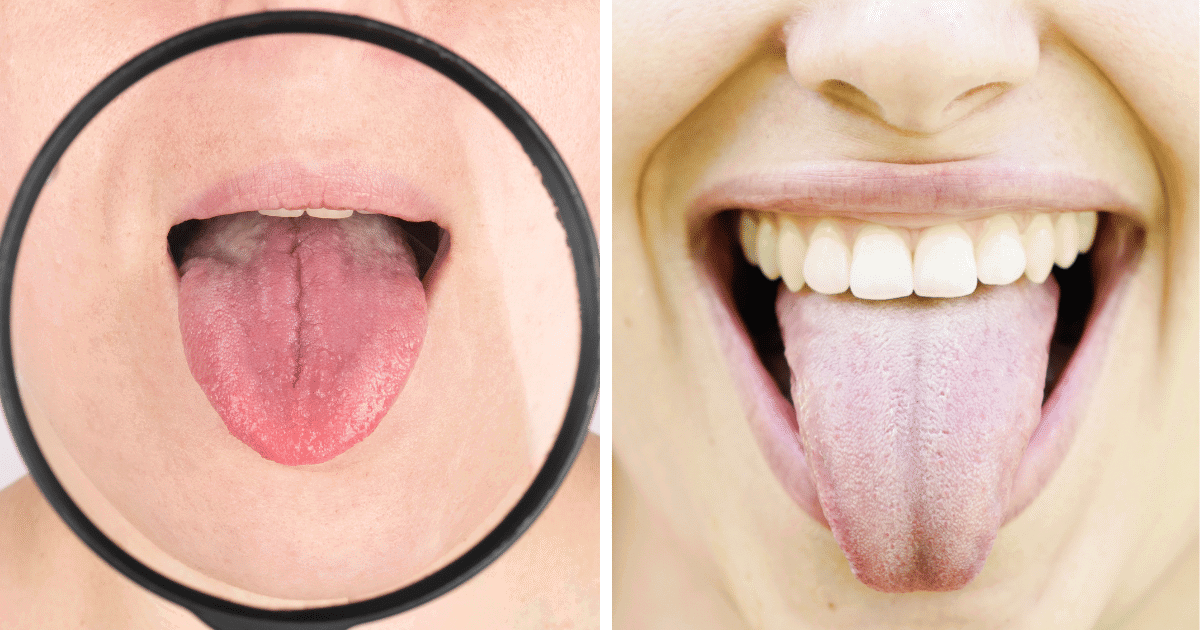 white tongue