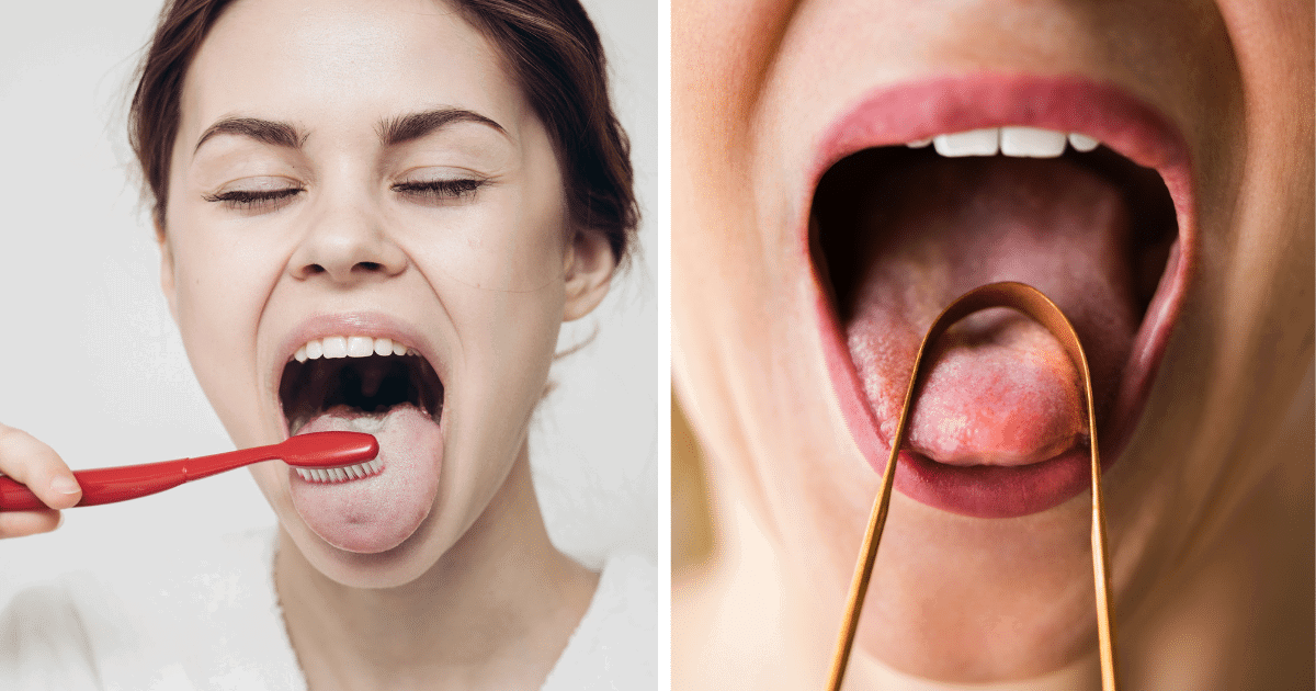 white tongue