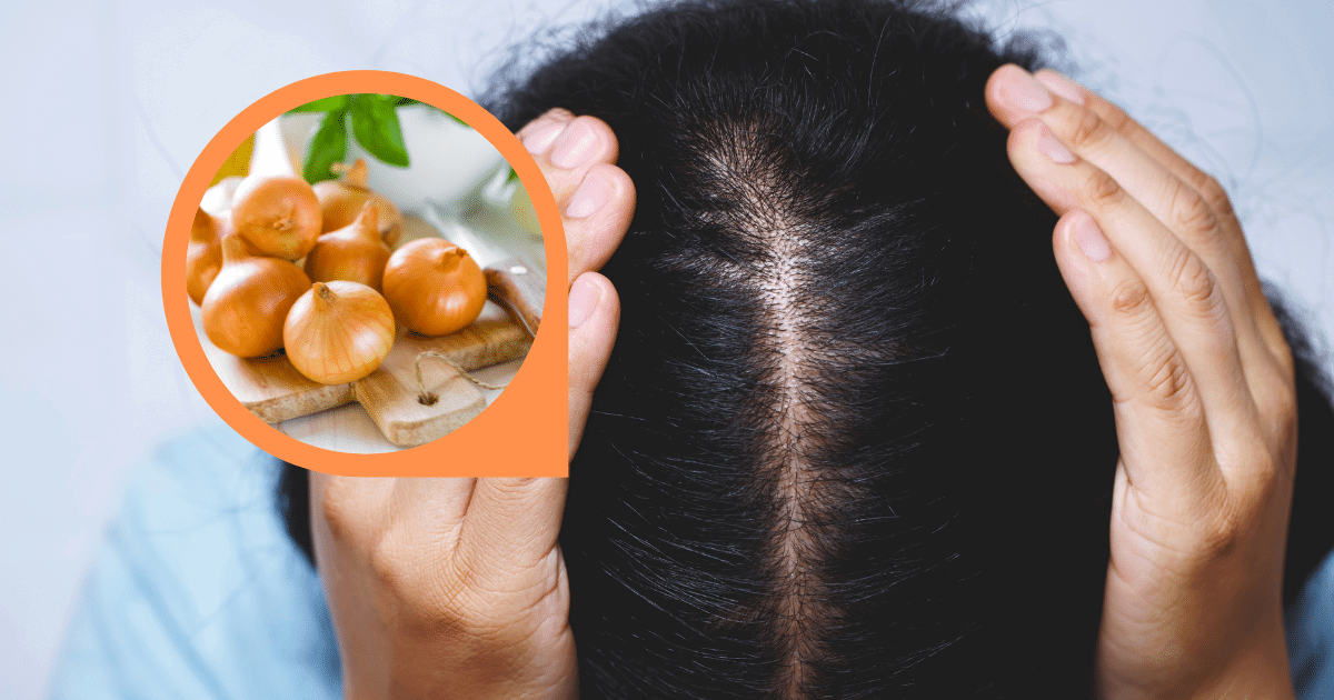 Hair Loss