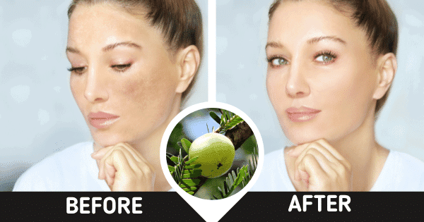 Face Pigmentation