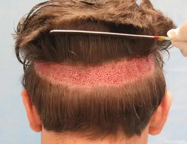 Trypophobia