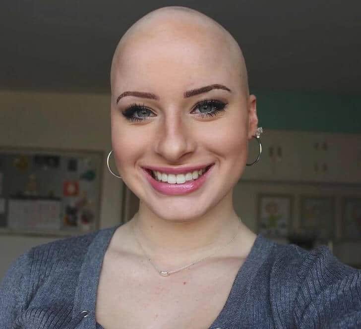 Alopecia