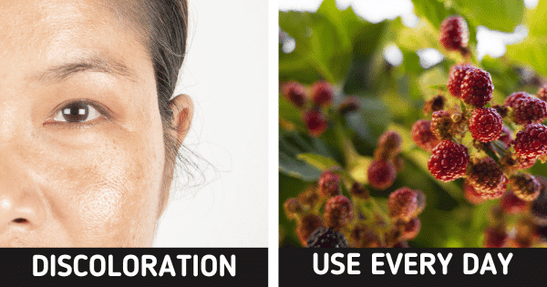 Face Pigmentation