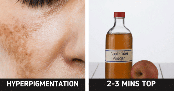 Face Pigmentation
