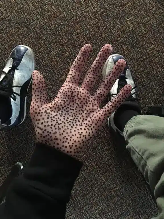 Trypophobia