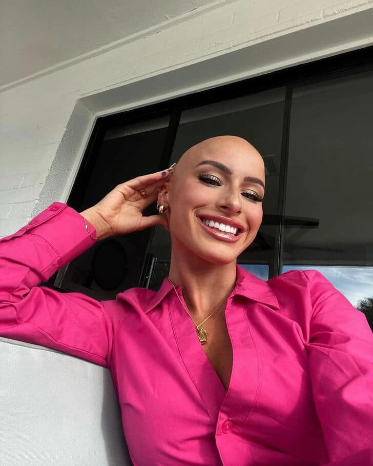 Alopecia