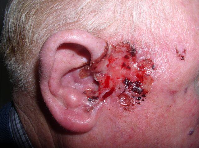 Skin Conditions