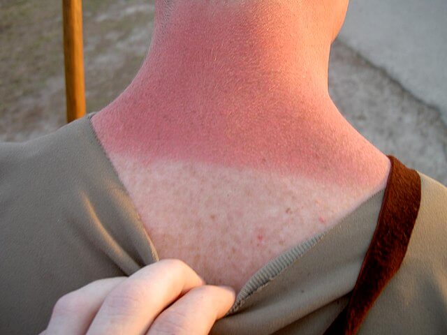 Skin Conditions