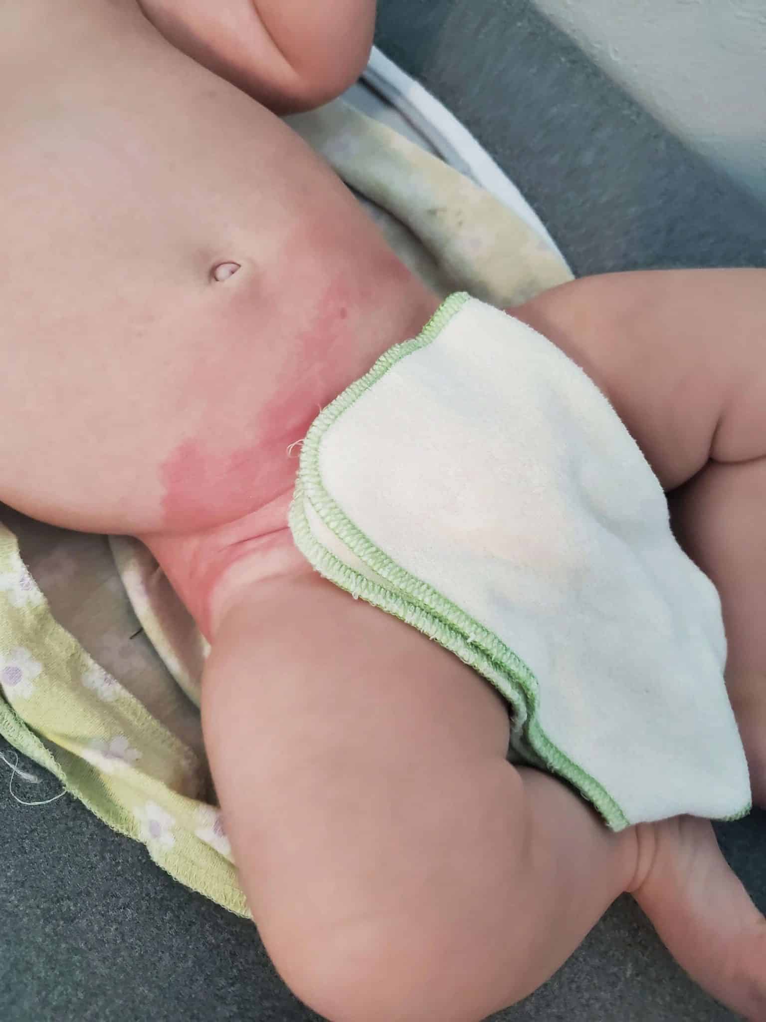 Skin Conditions