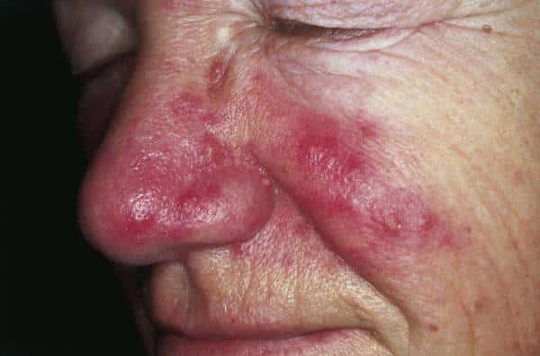 Skin Conditions