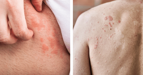 cold urticaria