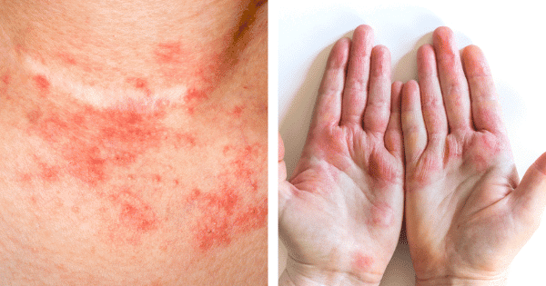 Eczema