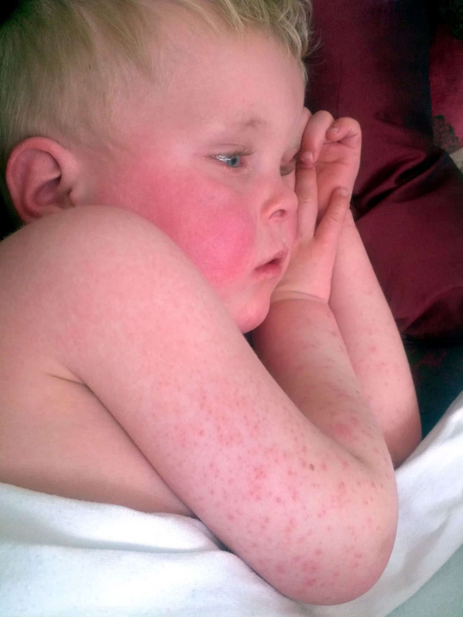scarlet fever