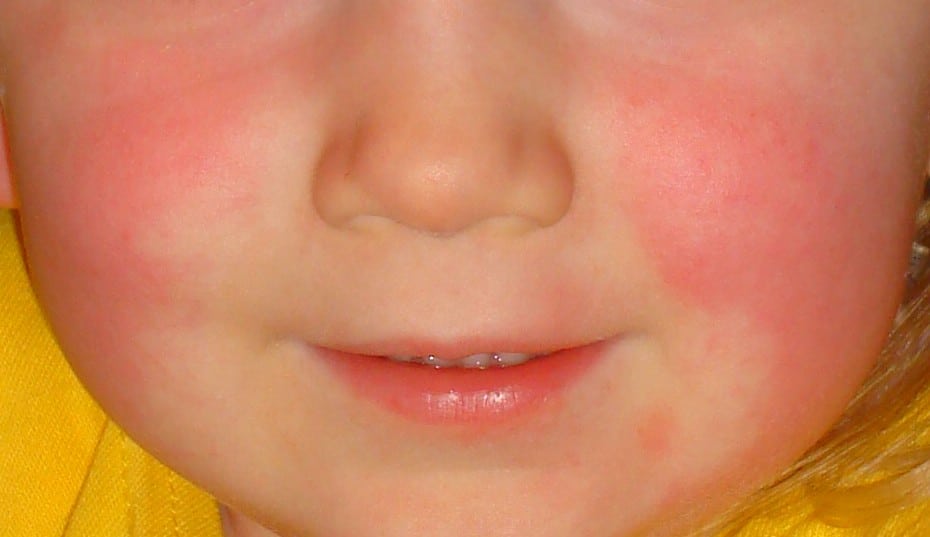 scarlet fever