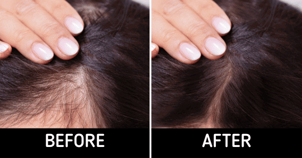 Hair Growth
