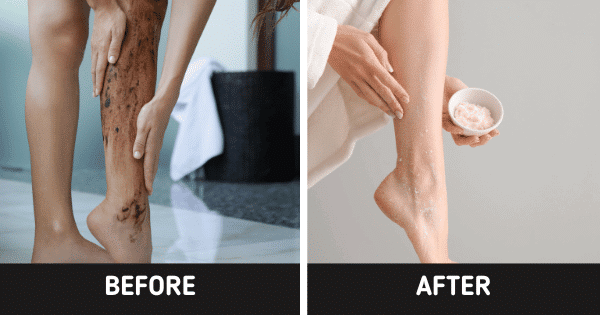 Leg Care