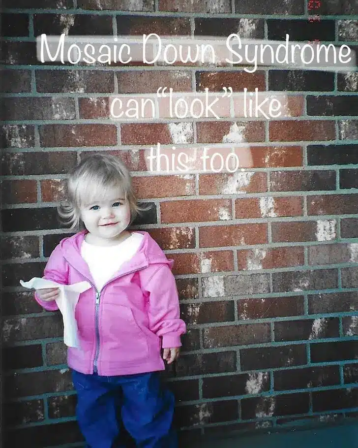 Down Syndrome