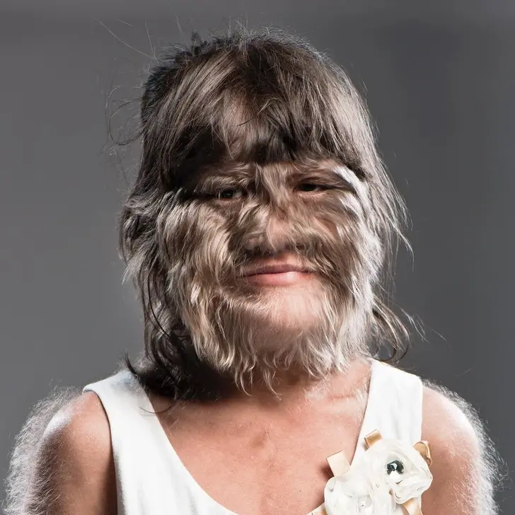 The World's Hairiest Girl