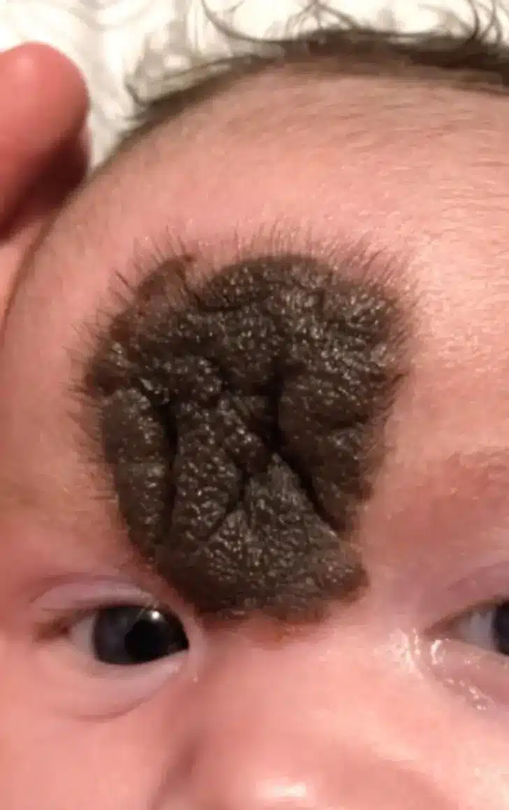 Rare Birthmark