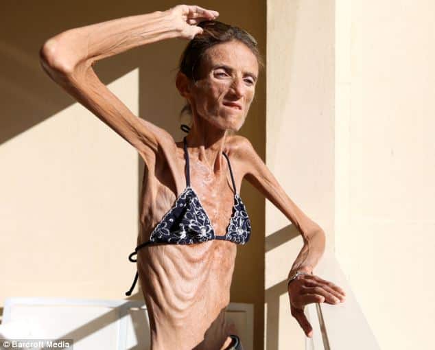 World's Thinnest Woman