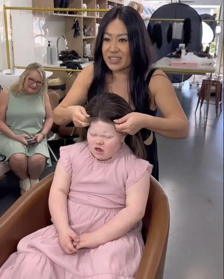 Girl with Alopecia