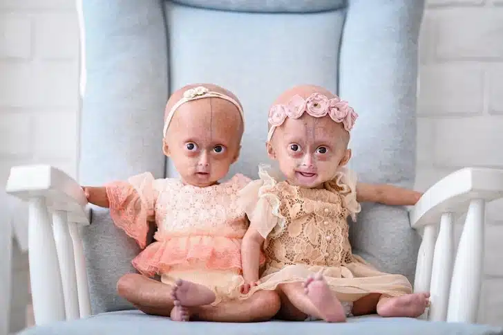 Benjamin Button Syndrome