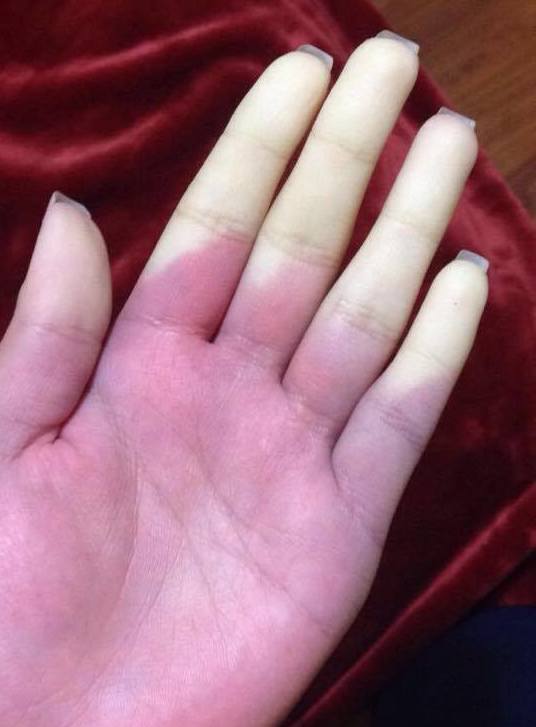 Raynaud's Phenomenon