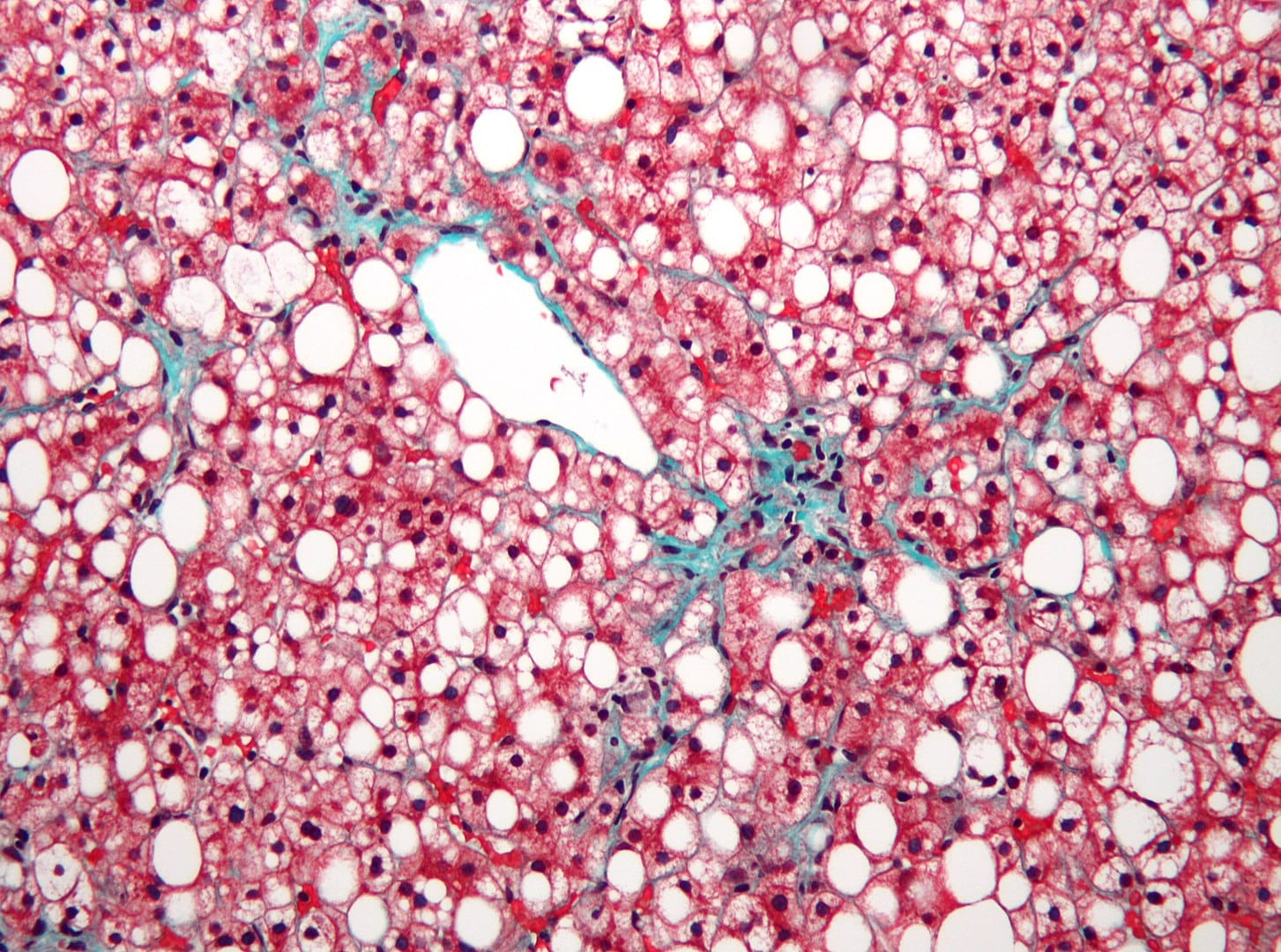 Fatty Liver Disease