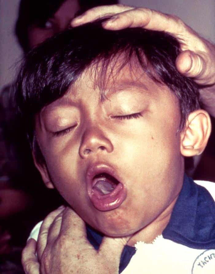 Diseases
