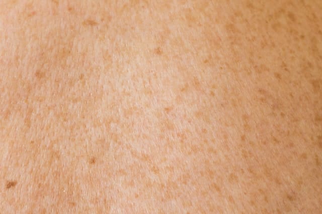 Age Spots