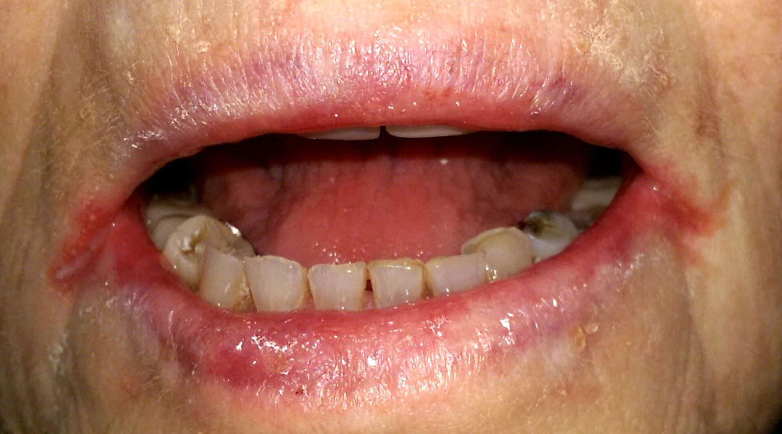 White Bumps on Lips