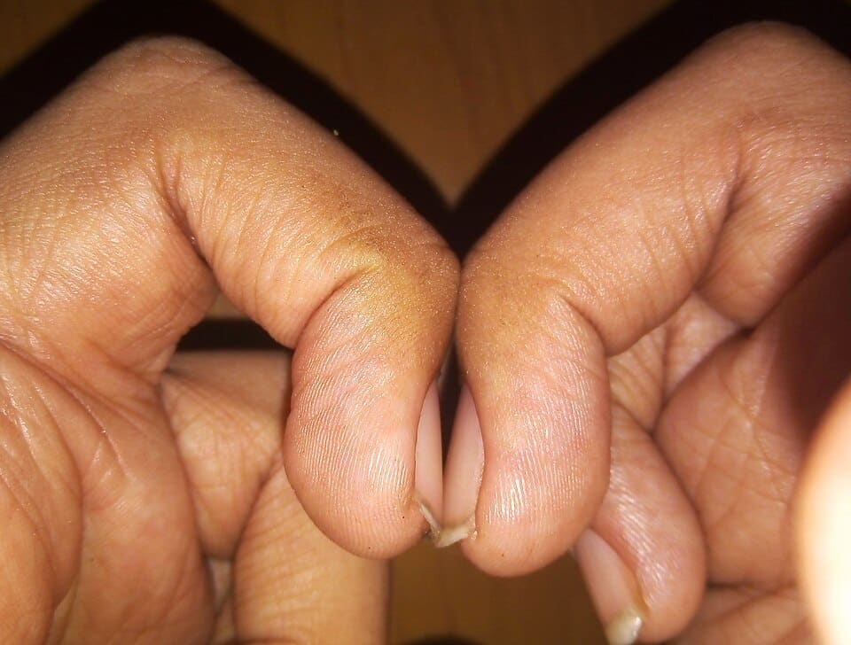 Finger Clubbing