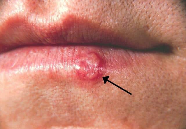 White Bumps on Lips