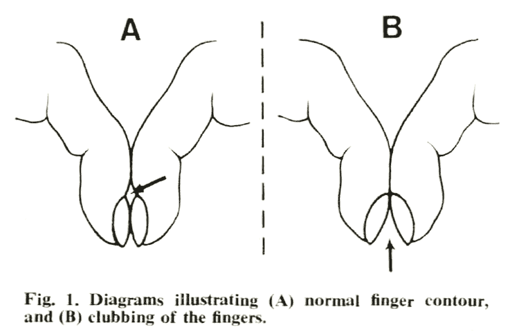 Finger Clubbing