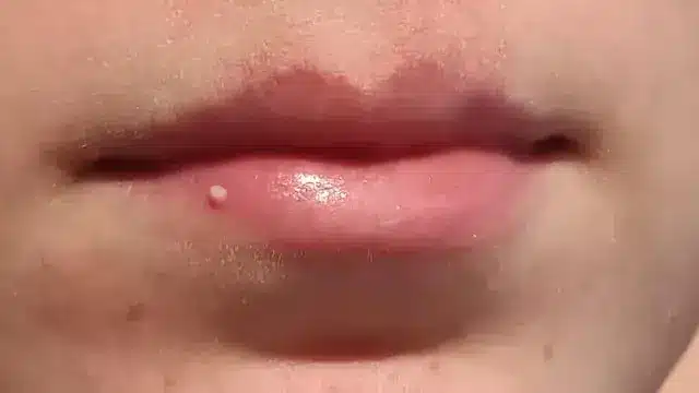 White Bumps on Lips