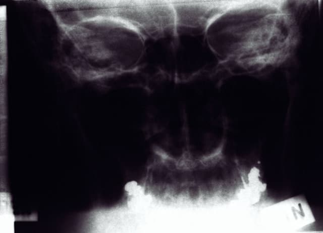 Fibromyalgia