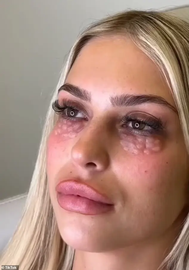 Mesotherapy