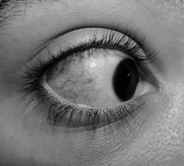 Eyelash Mites