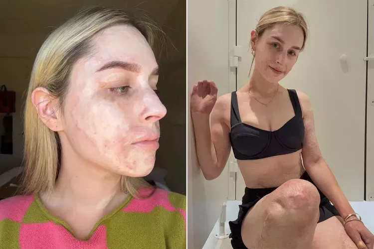 Volcano survivor