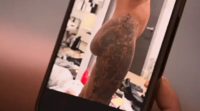 Butt Implants