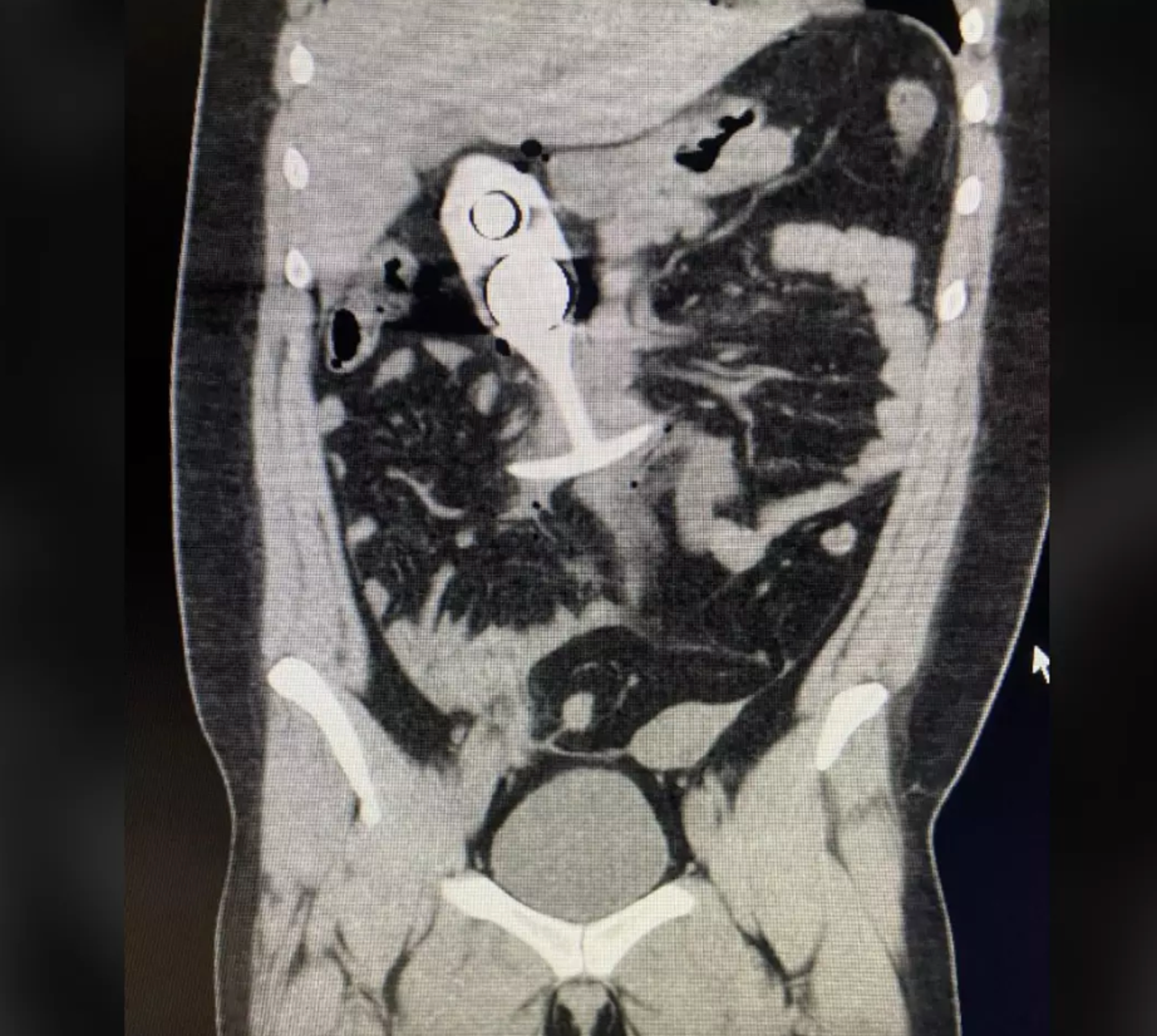 MRI Incident