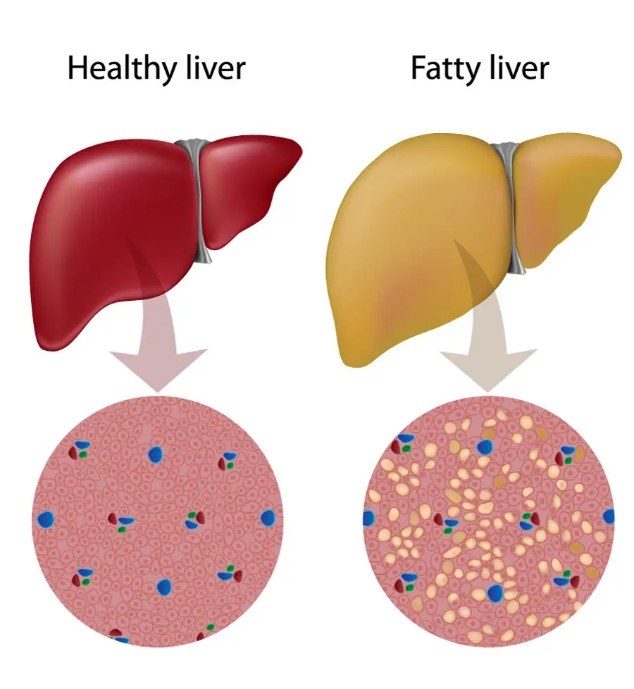 NAFLD